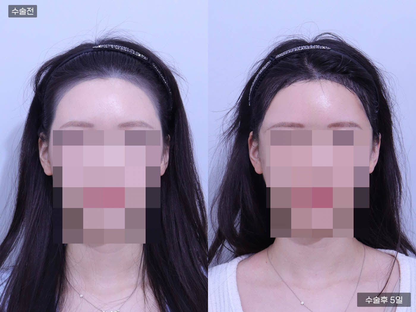 모발이식[비절개 모발이식(2000모)]