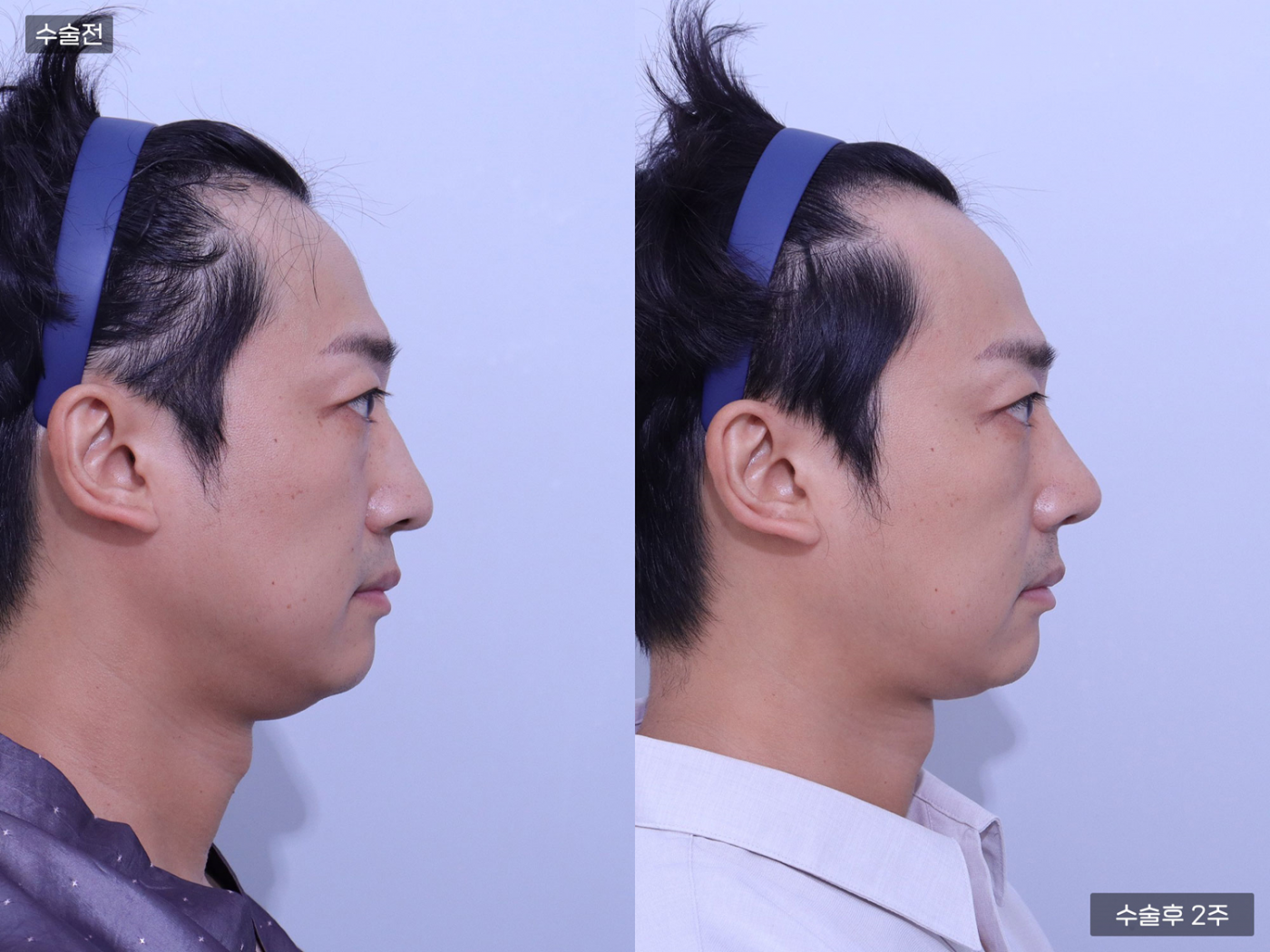 코끝 + 복코 + 매부리코