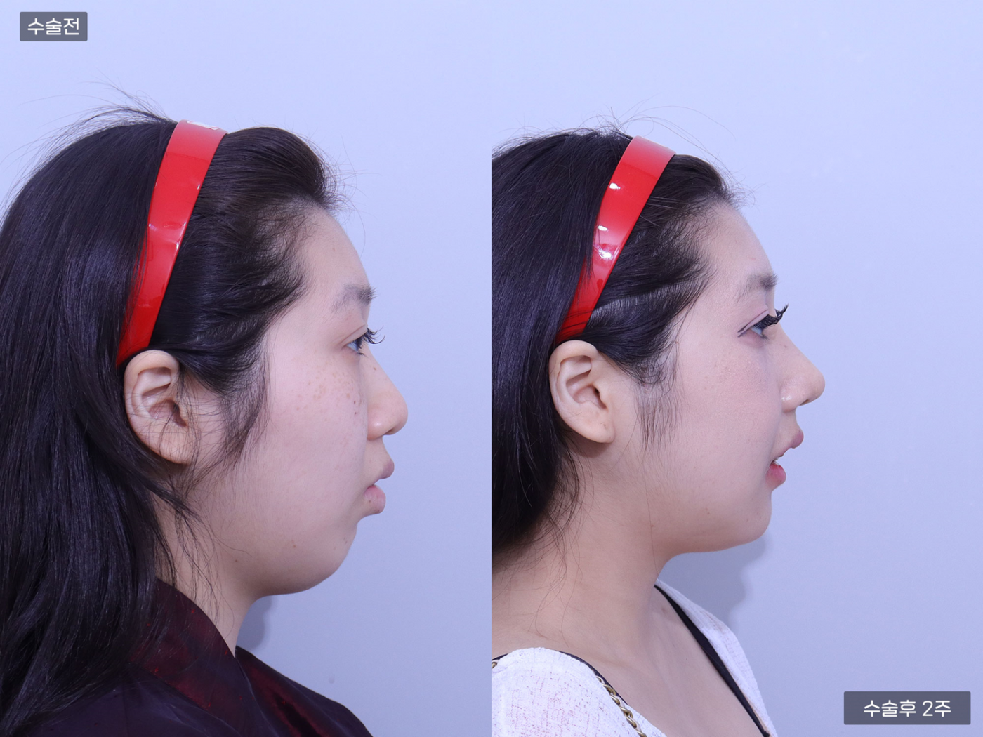 복코 + 매부리코 + 코끝 + 콧볼축소