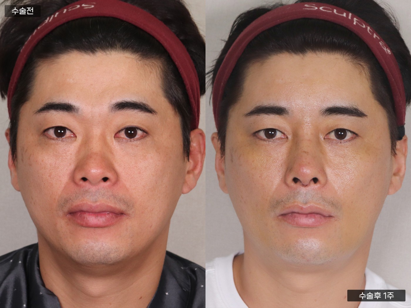 지방이식 [풀페이스]