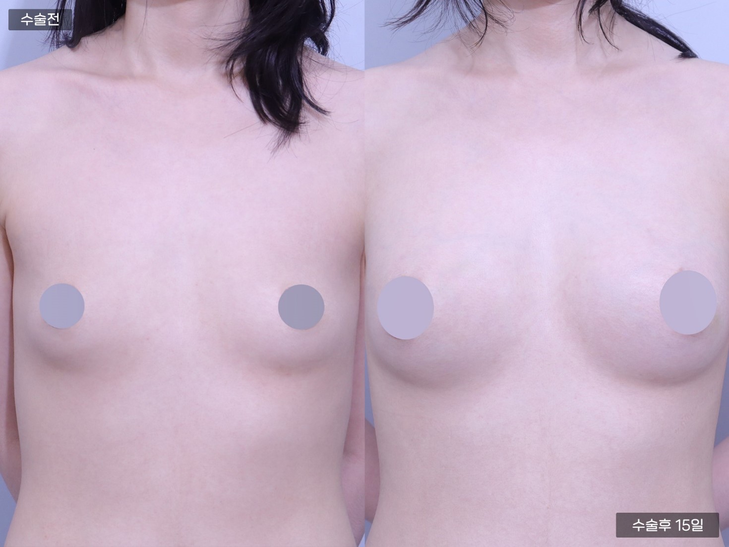 PRP 가슴지방이식 (250cc + 250cc)