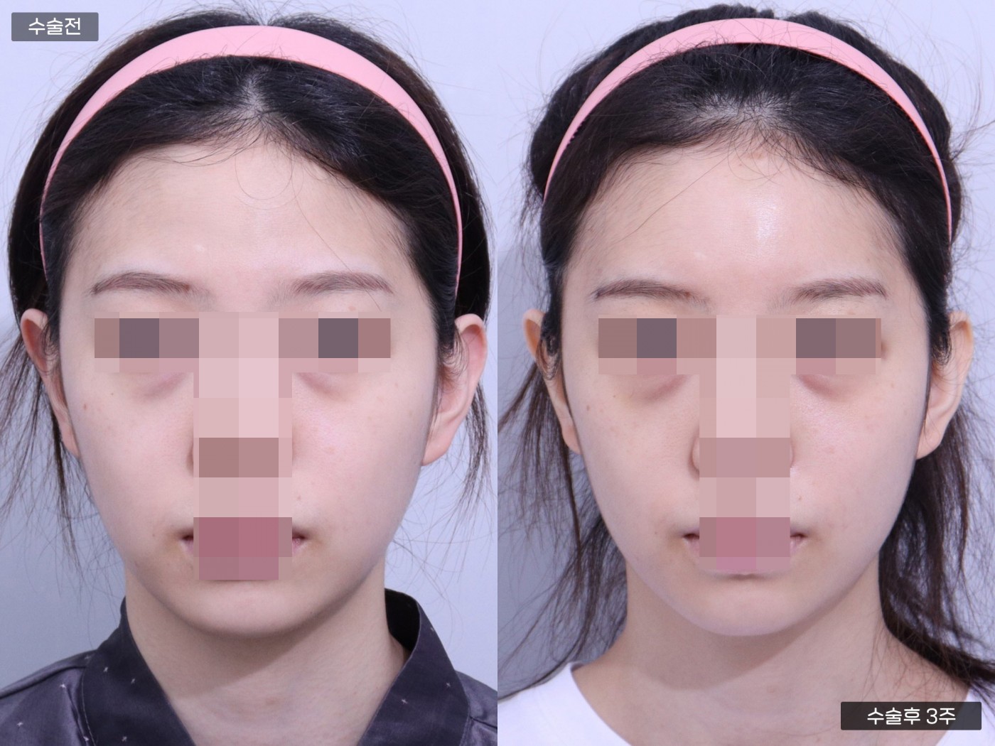 지방이식 [이마]