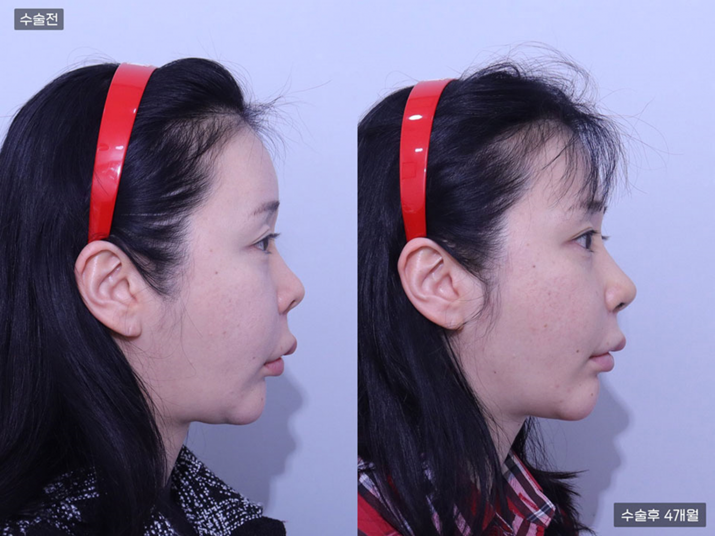 비공내리기 + 매부리코