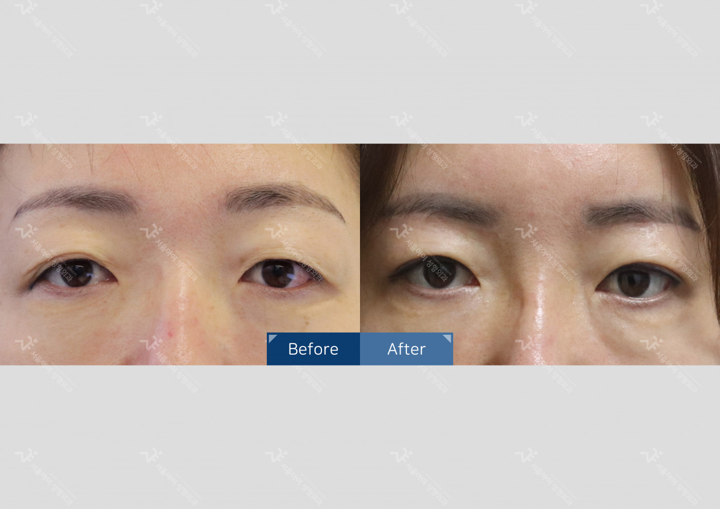 눈성형 [눈썹하거상술]