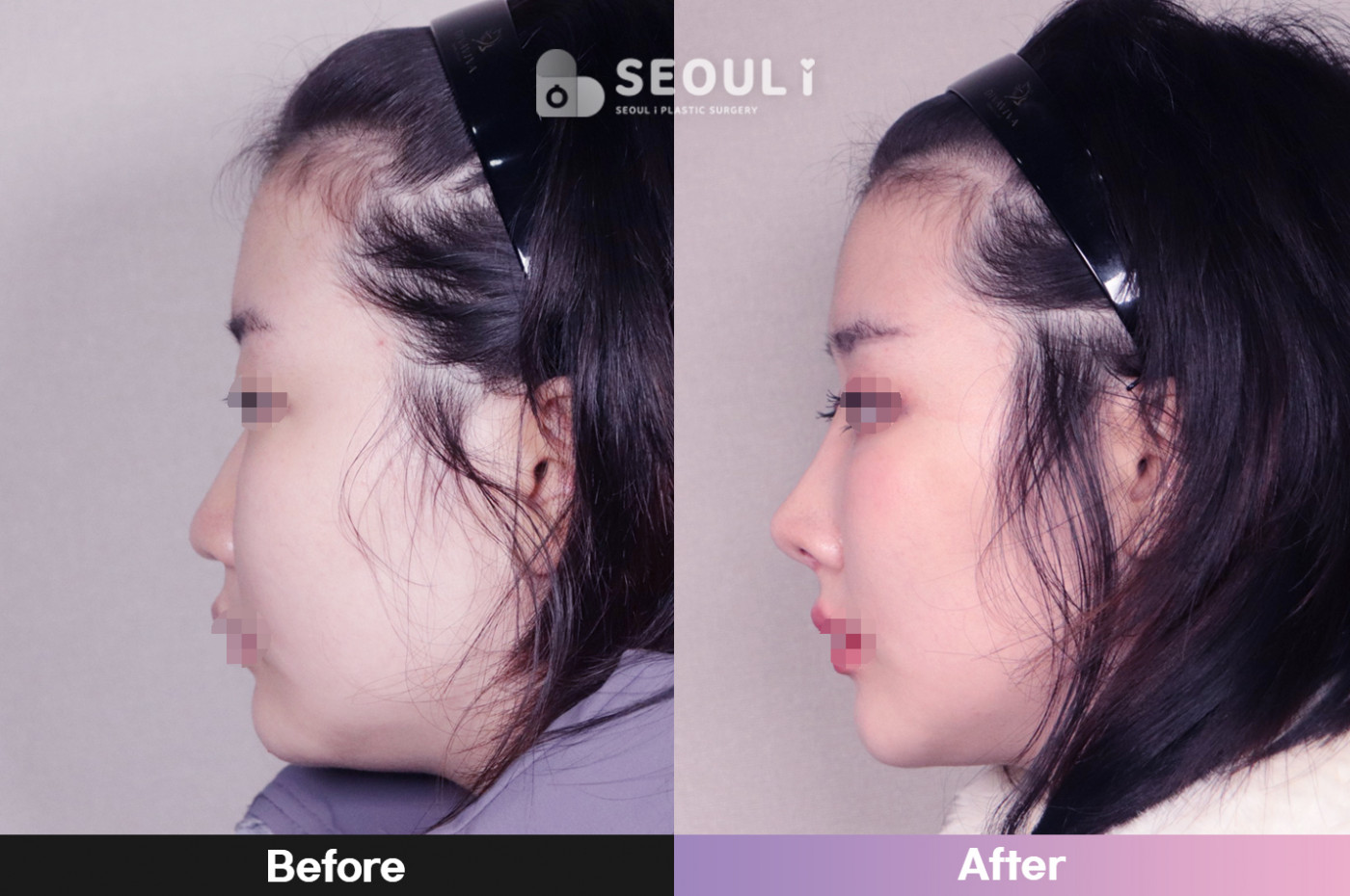 코끝(비중격) + 콧볼 축소술 + 매부리 교정