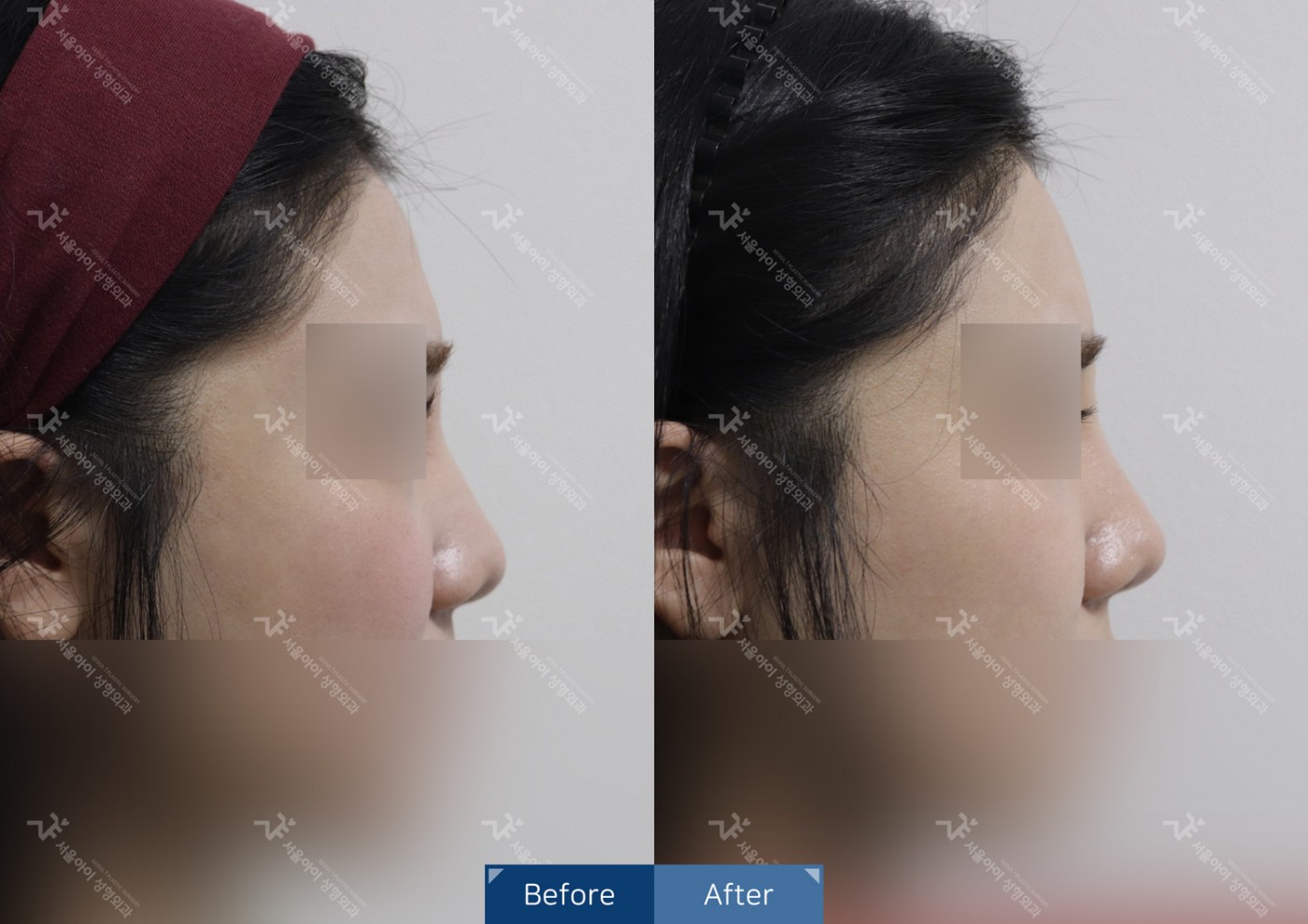 코성형 [비절개콧볼축소+하이코]