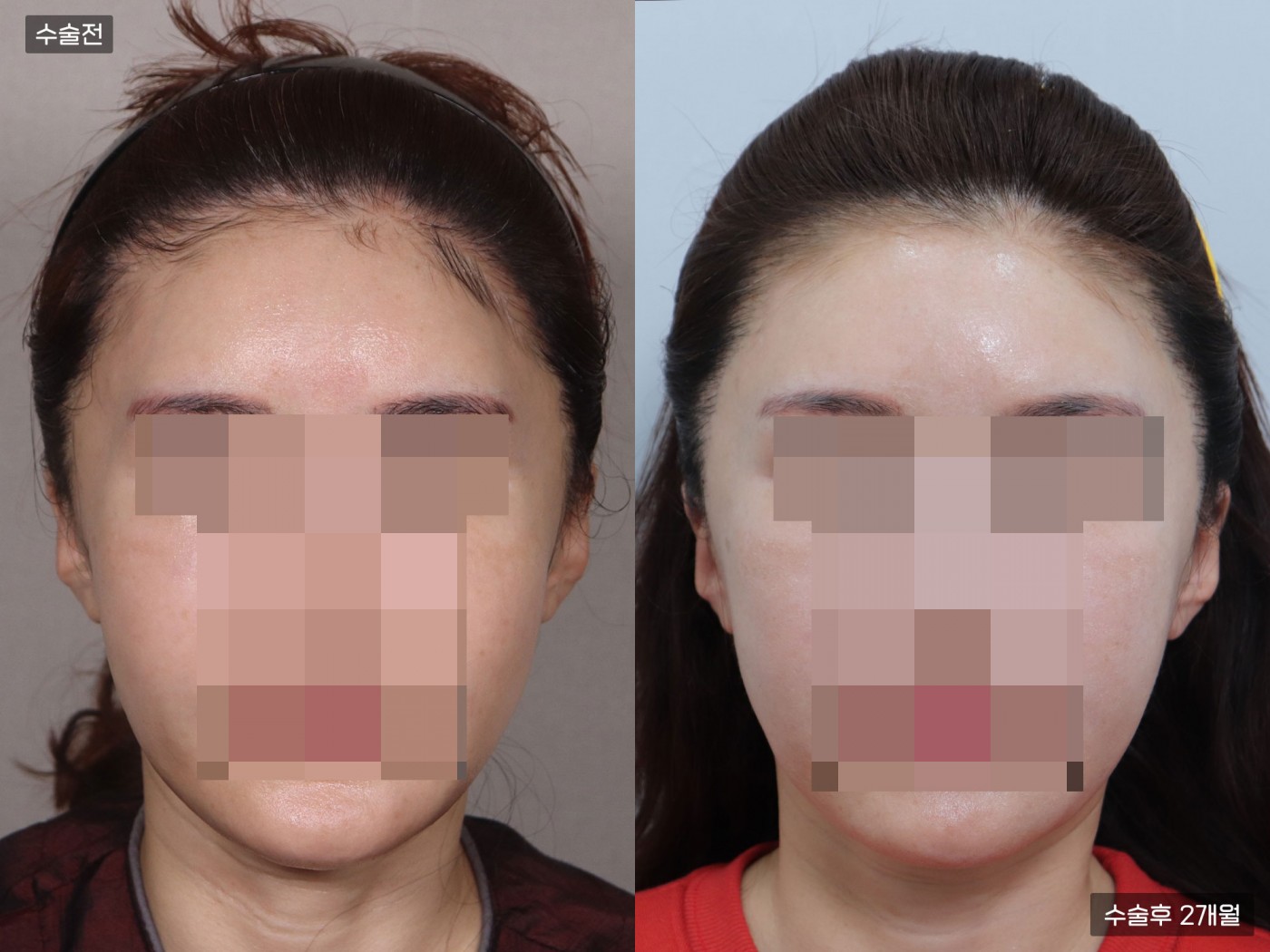 모발이식[비절개 모발이식(2000모)]