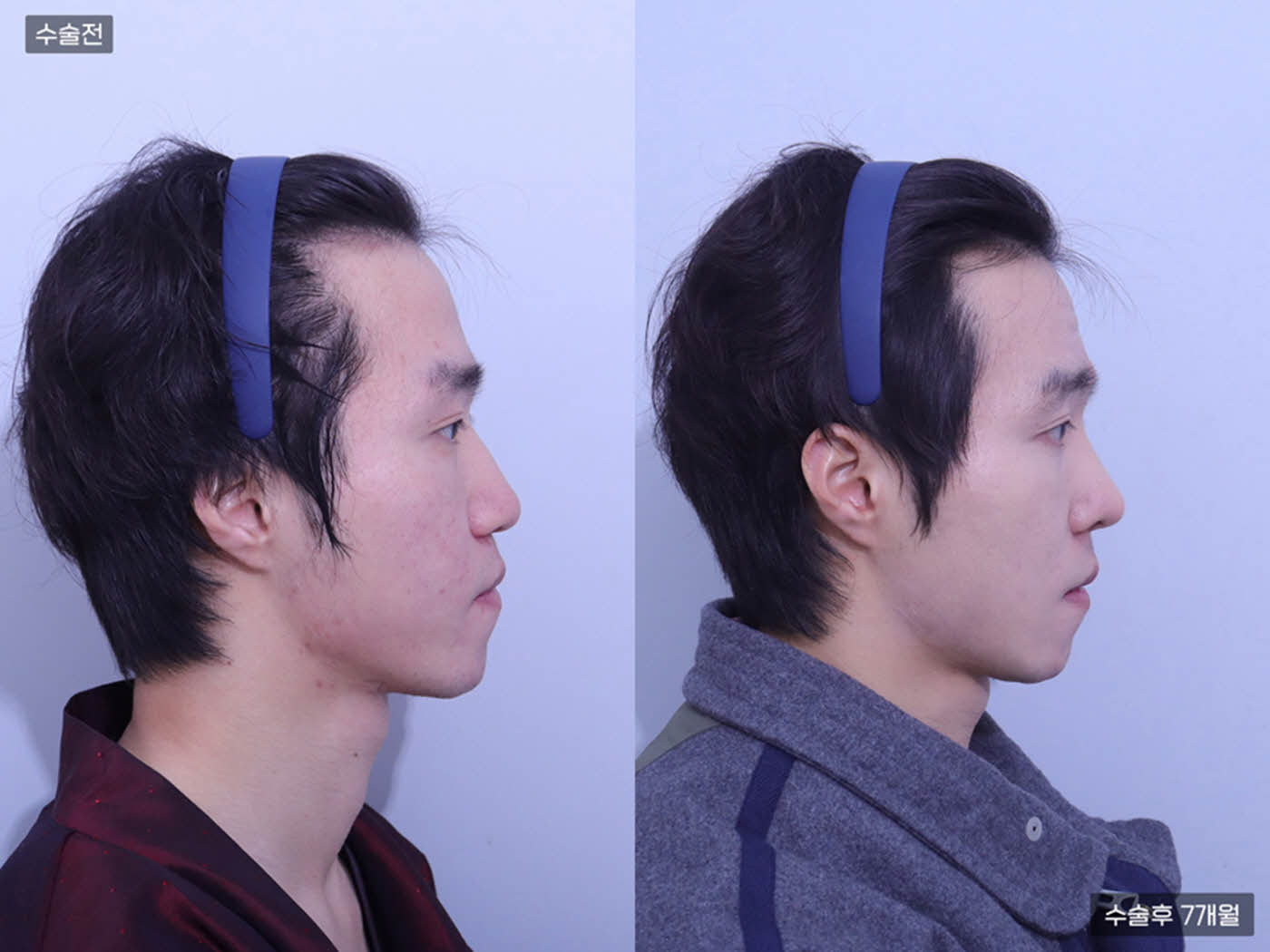 코끝 + 콧볼축소 + 복코교정 + 매부리코