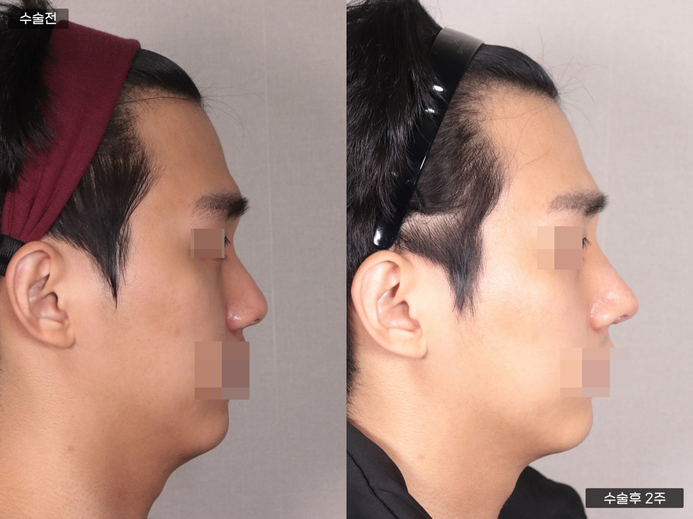 낮은코 + 복코 + 매부리코