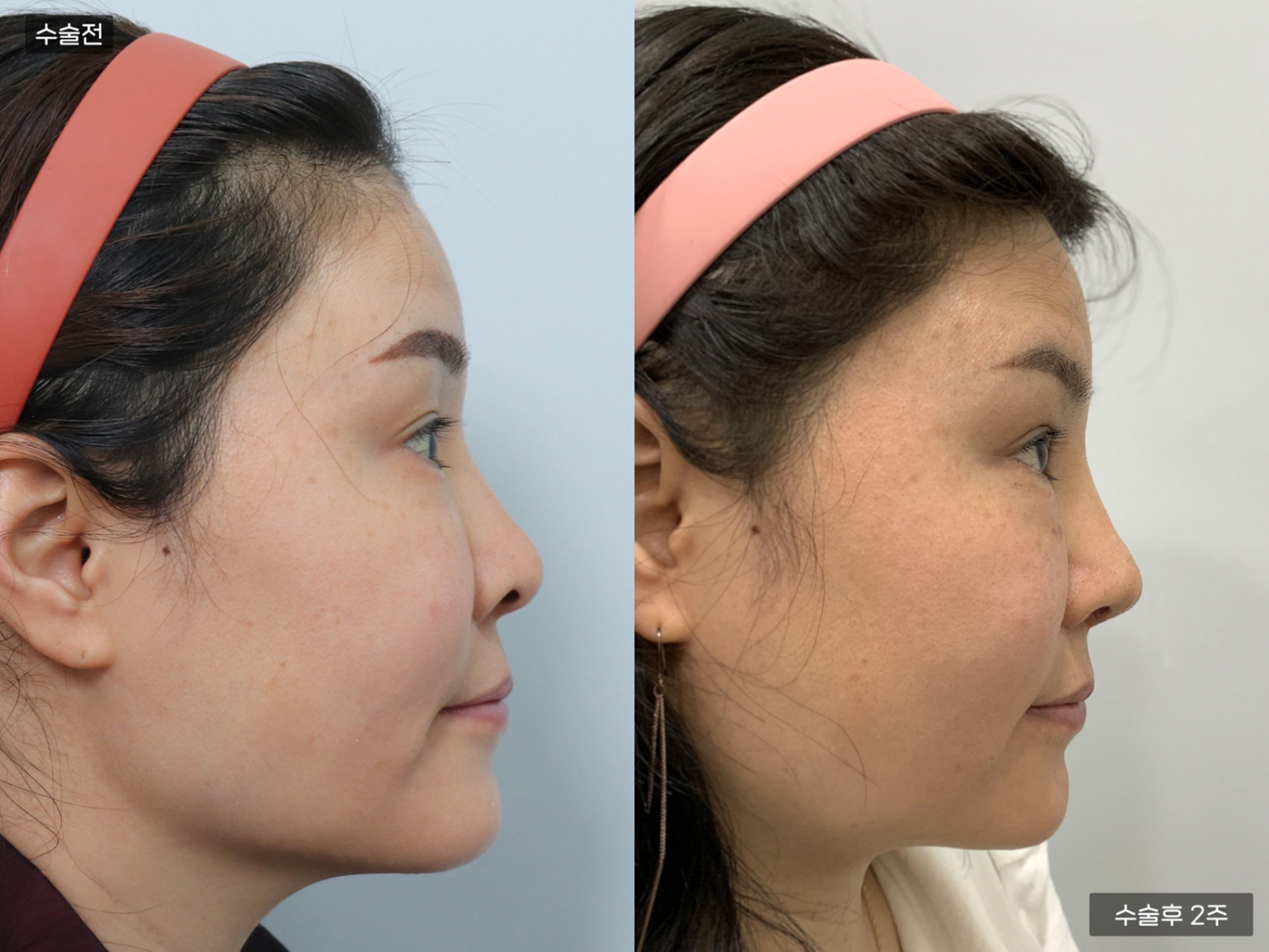 비공내리기 + 복코 + 매부리코