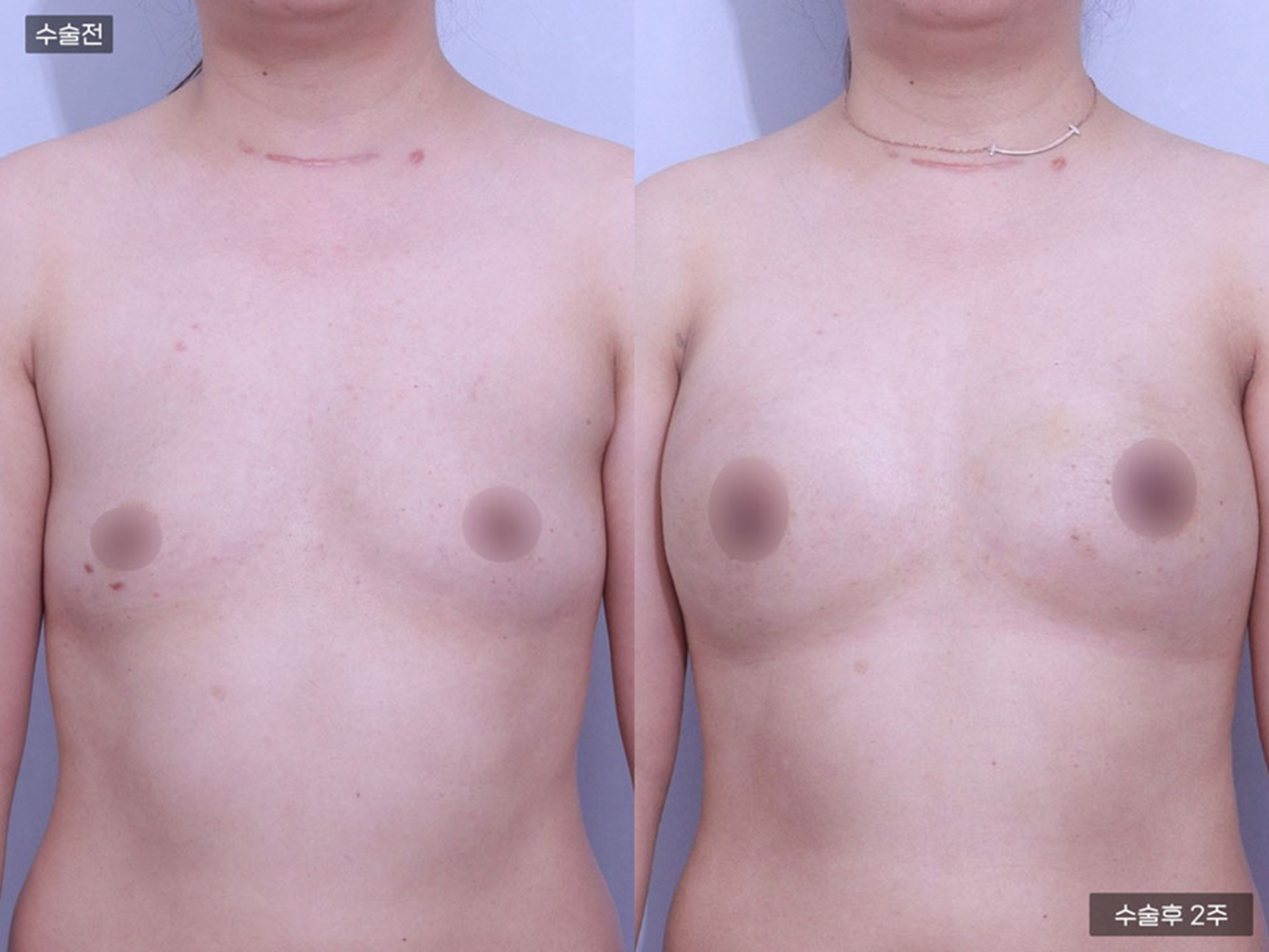 가슴성형 [가슴지방이식(2500CC + 250CC)]