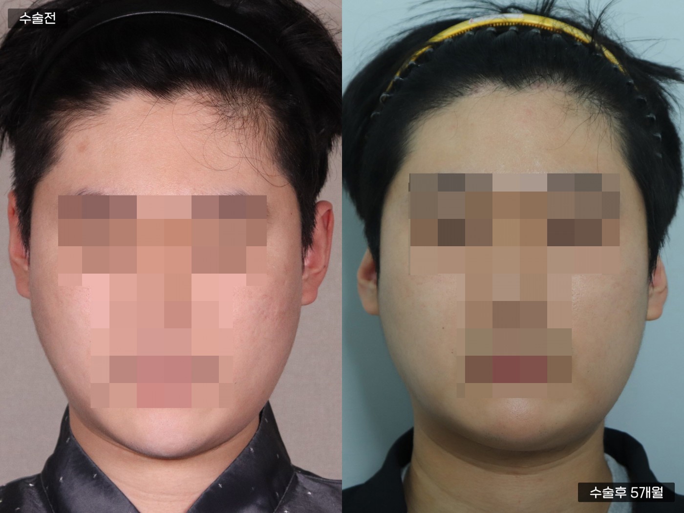 모발이식 [비절개 모발이식(3000모)]