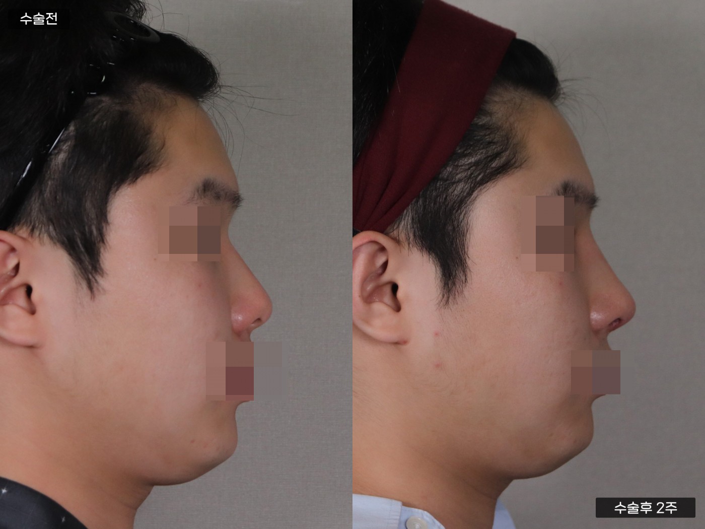 낮은코 + 복코 + 매부리코 + 콧볼축소