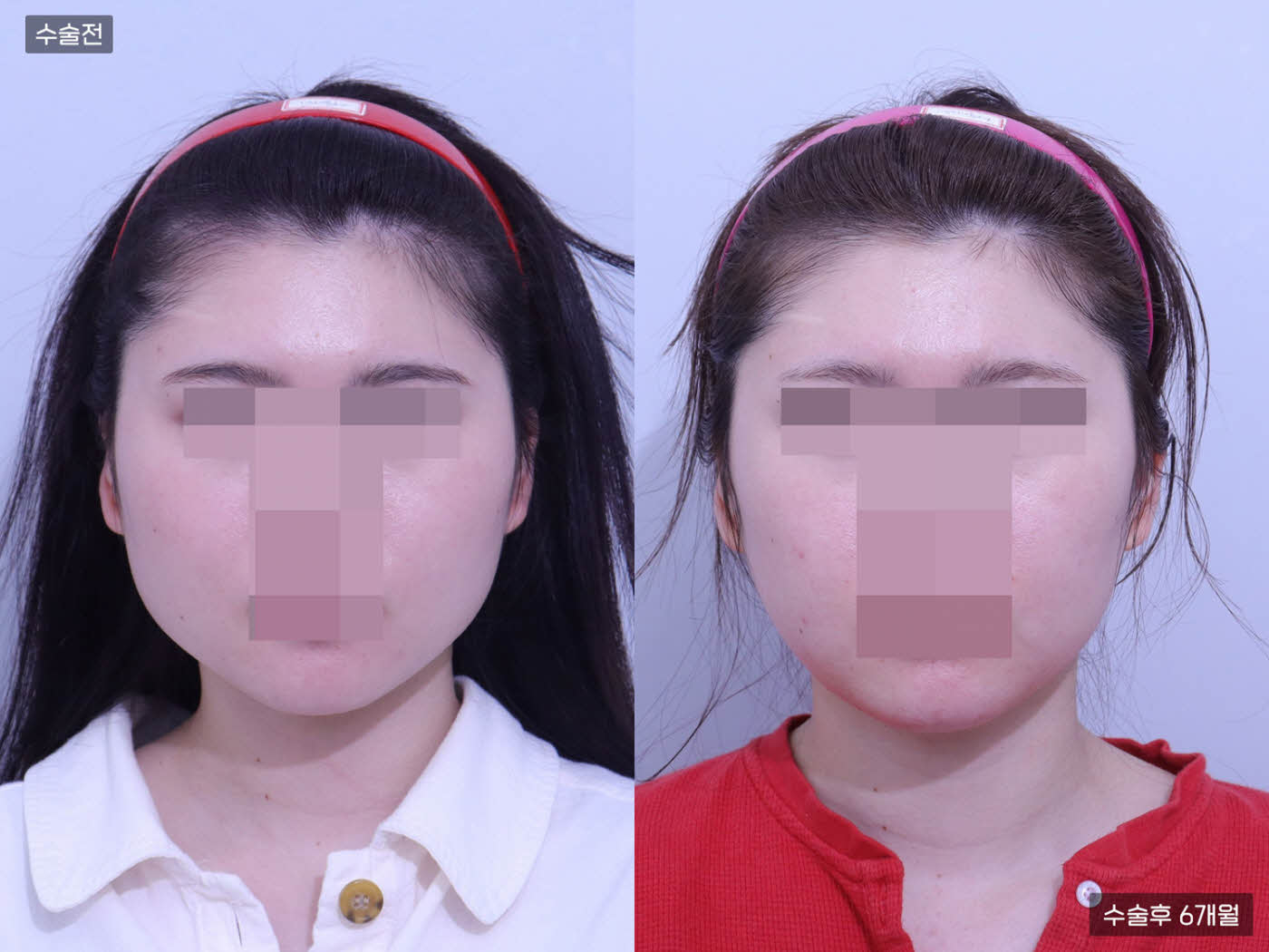 사각턱 + 광대뼈