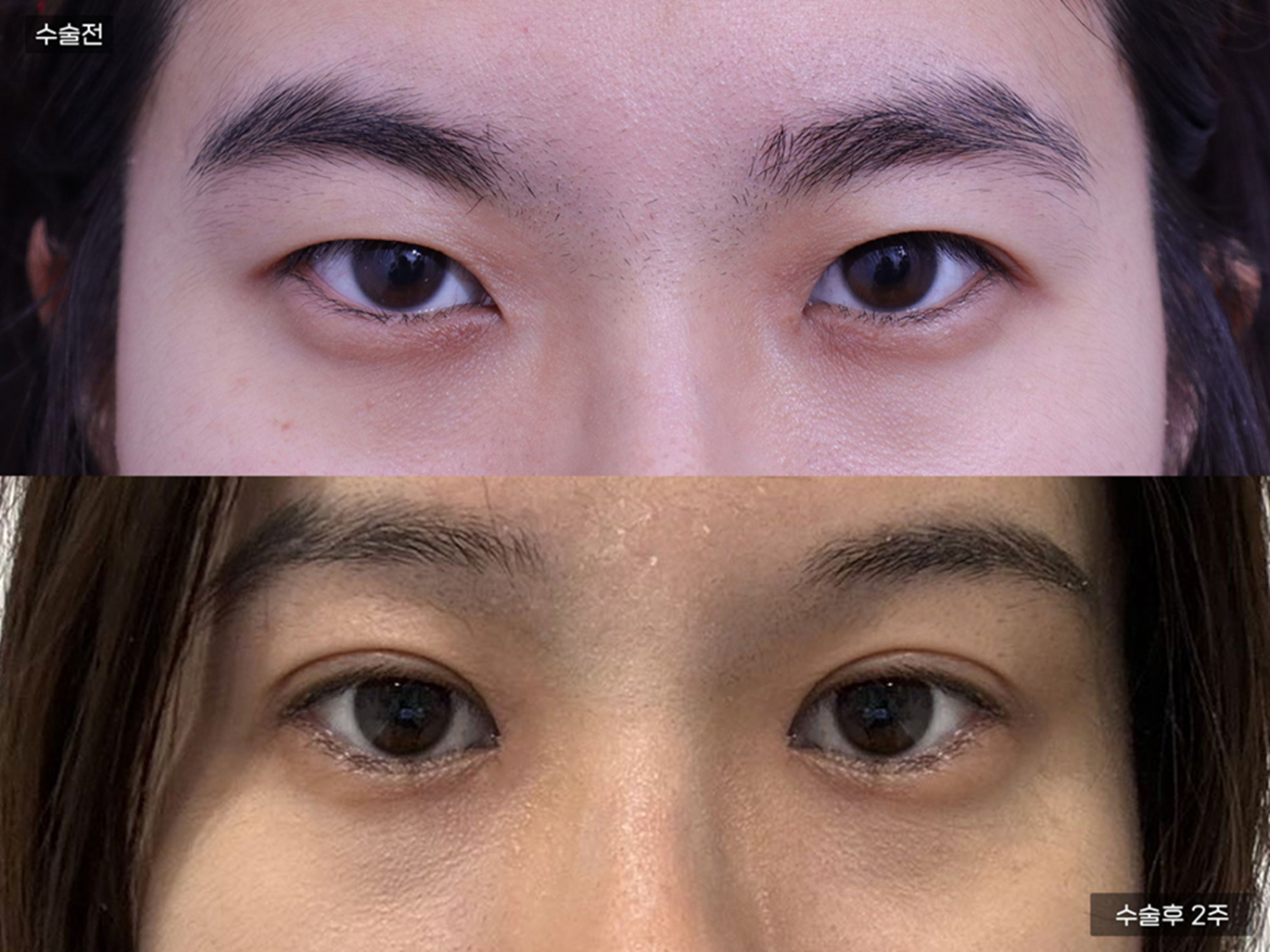 눈성형 [자연유착 쌍꺼풀]