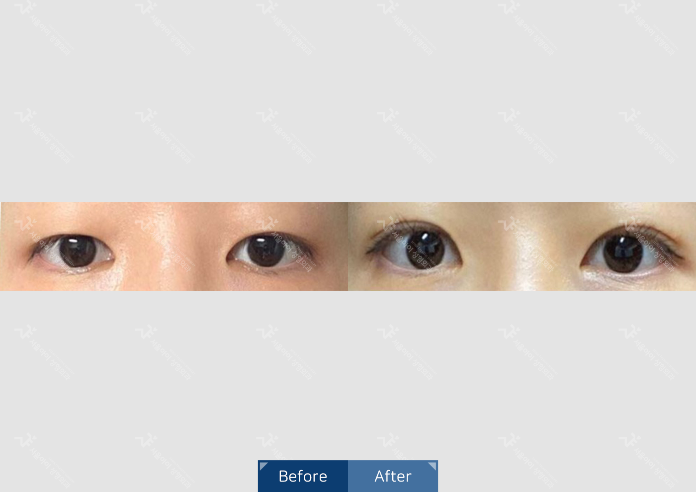 눈성형 [자연유착 쌍꺼풀]