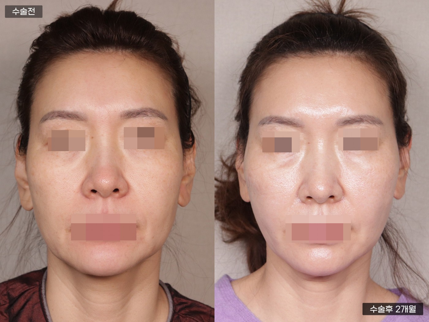 리프팅 [관자거상]