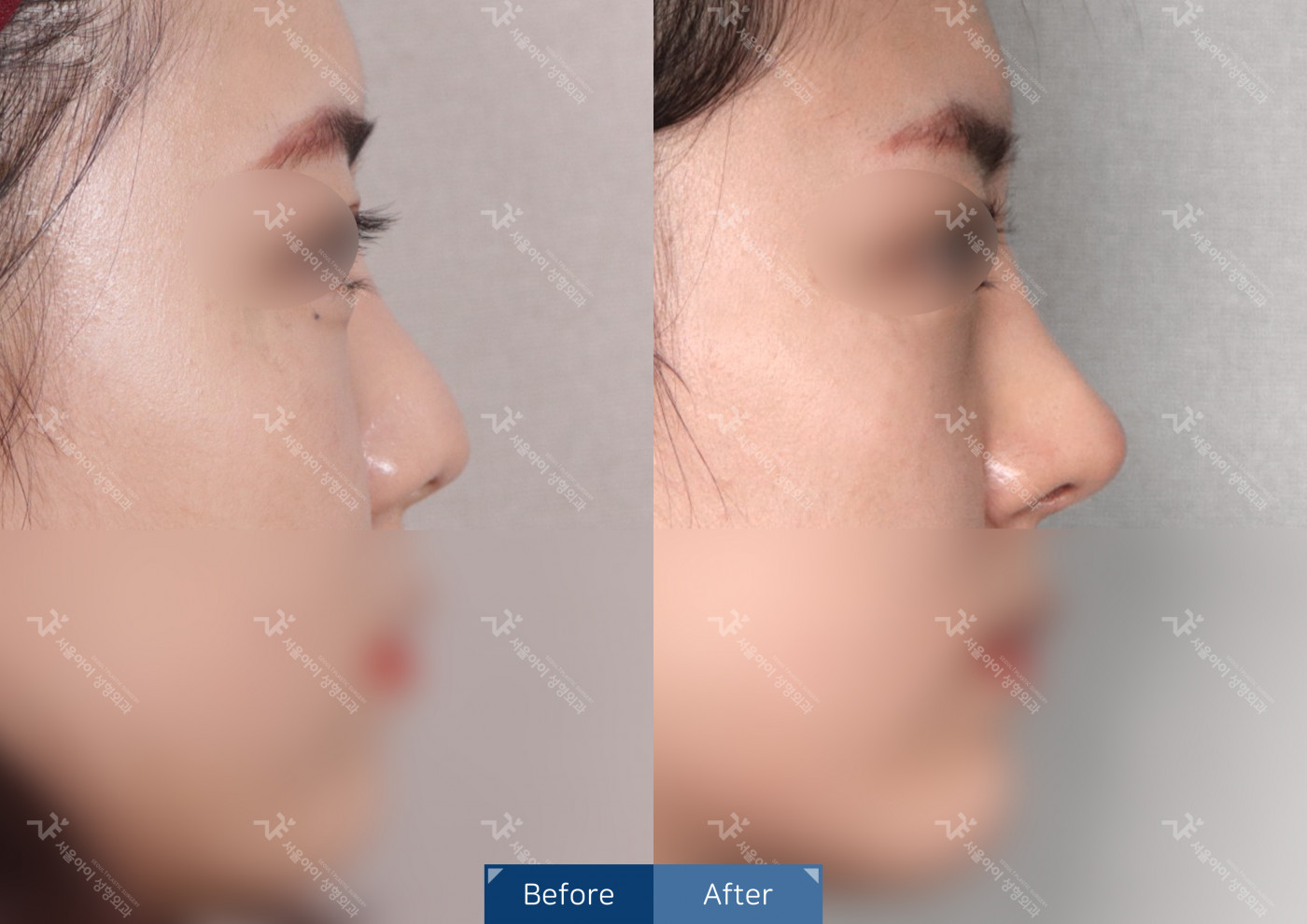 코성형 [융비술&코끝조각술(비중격)+복코교정술+메부리코]