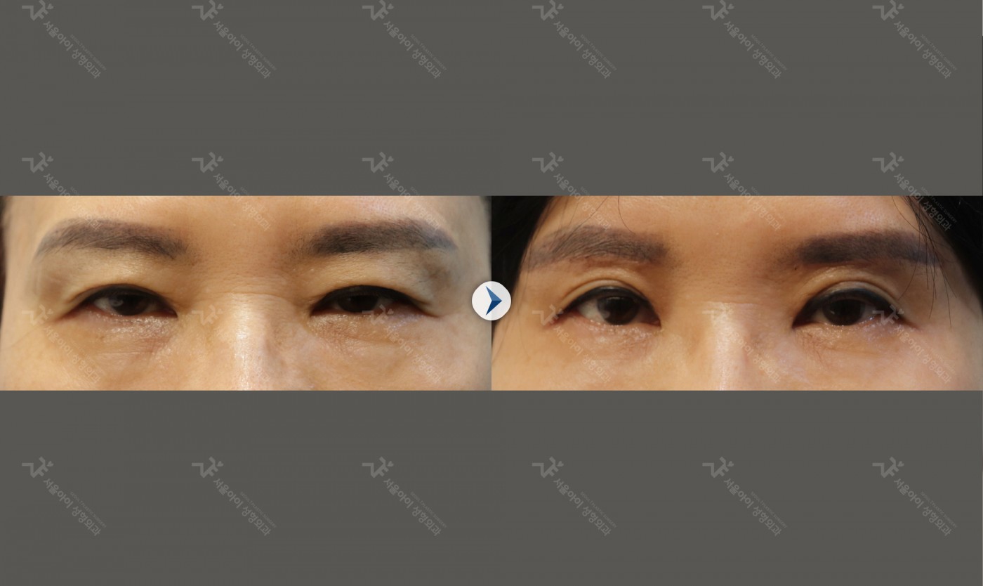 눈성형 [눈썹하거상술]