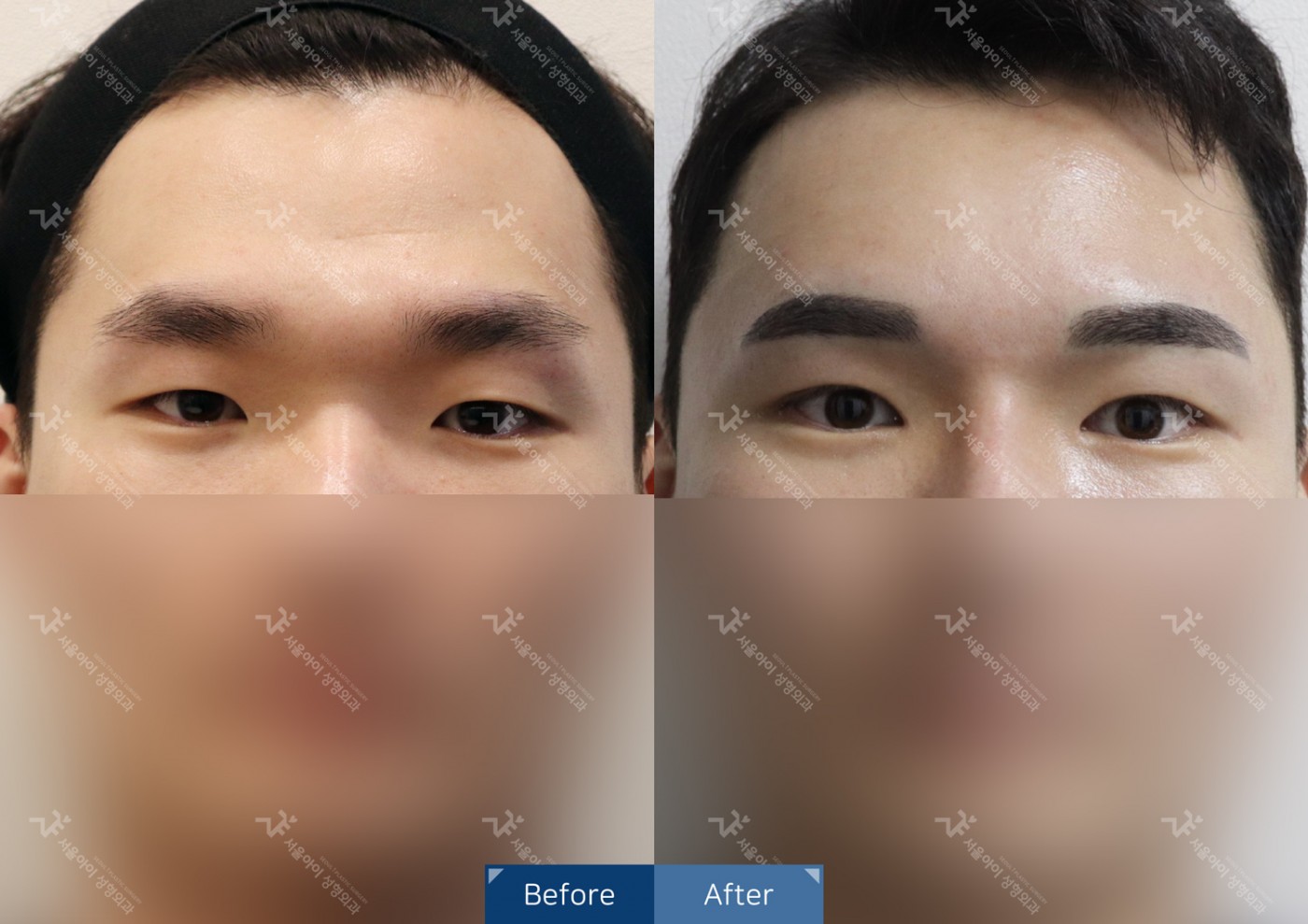 눈성형 [자연유착 쌍꺼풀 + 앞트임]