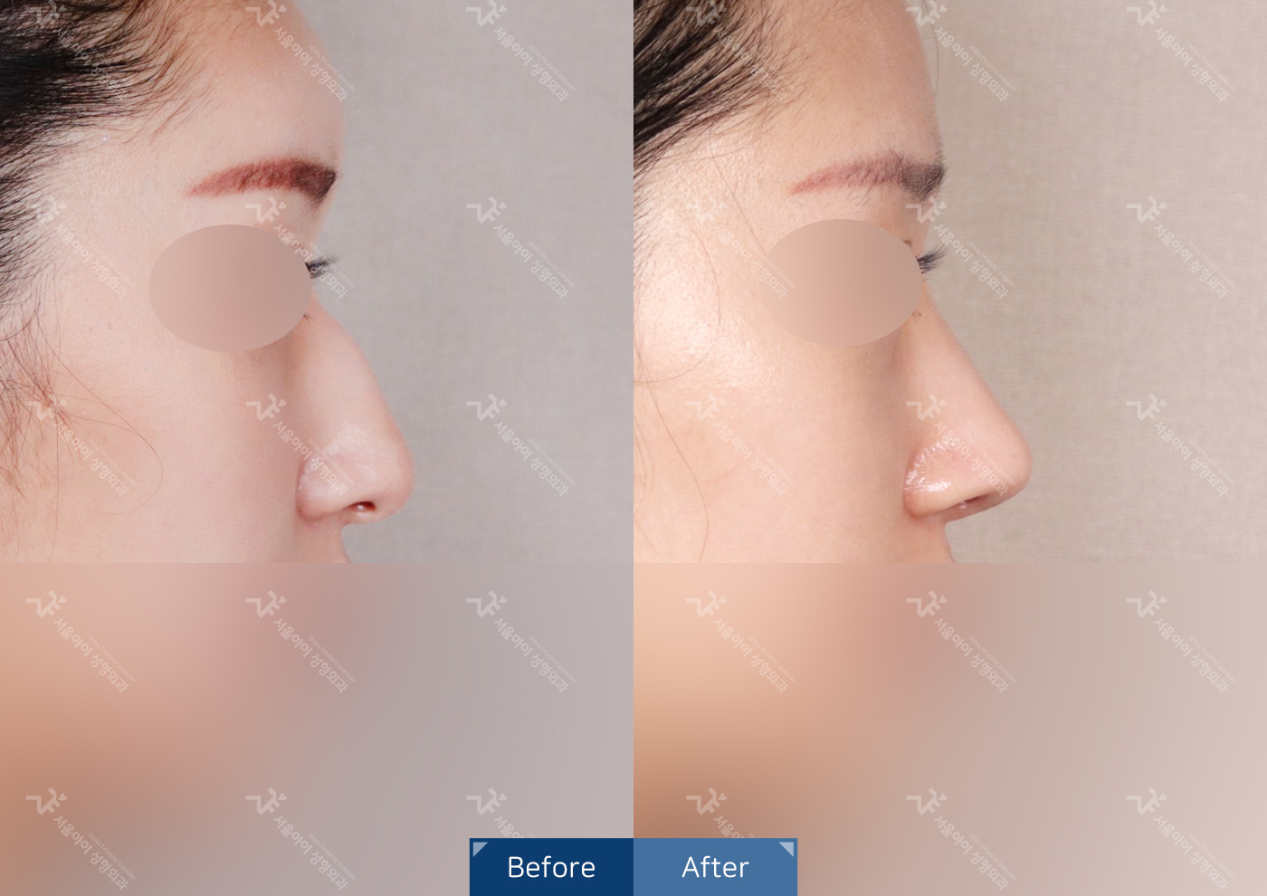 코성형 [기능2종+미용코]