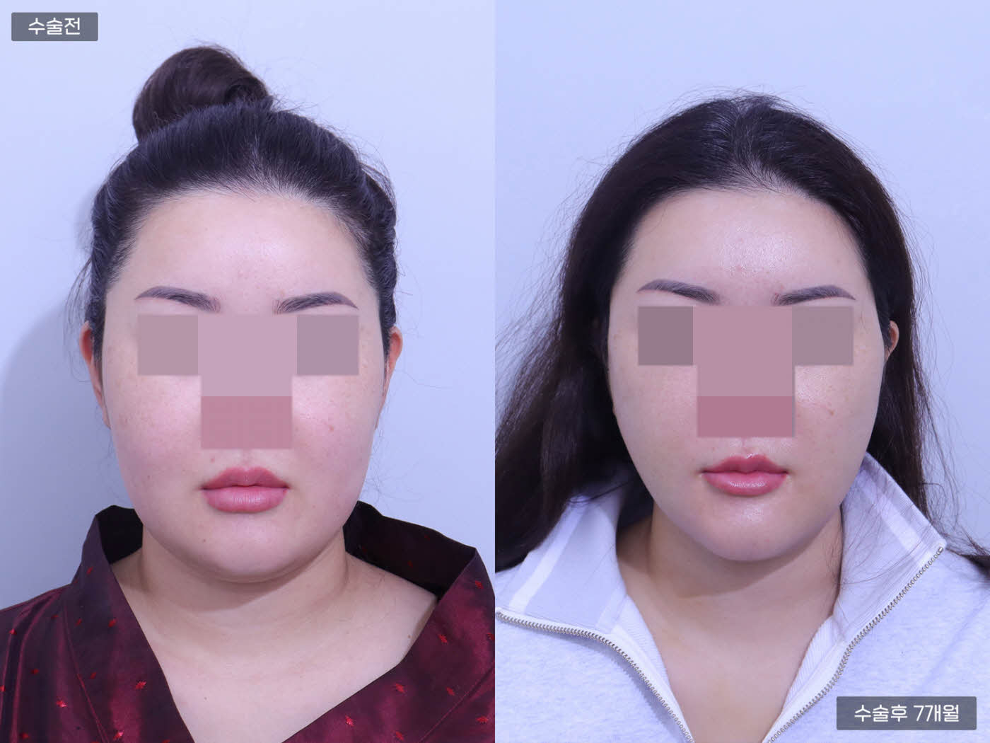 턱 지방흡입[이중턱 지방흡입]