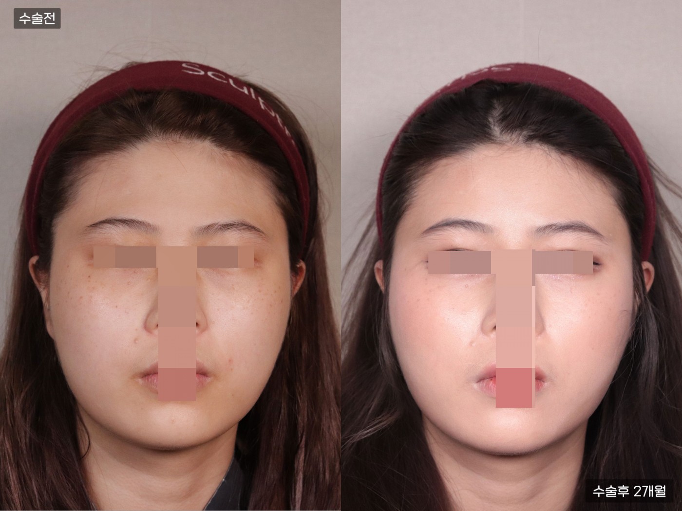 지방이식 [풀페이스]