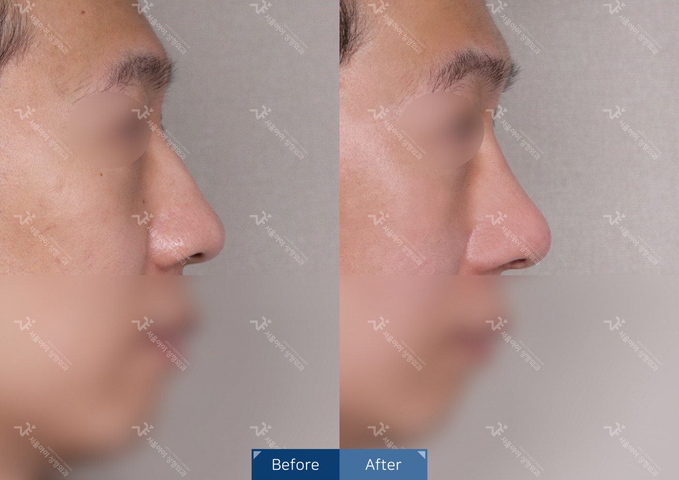 코성형 [코끝조각술+비중격+메부리코+복코교정술]