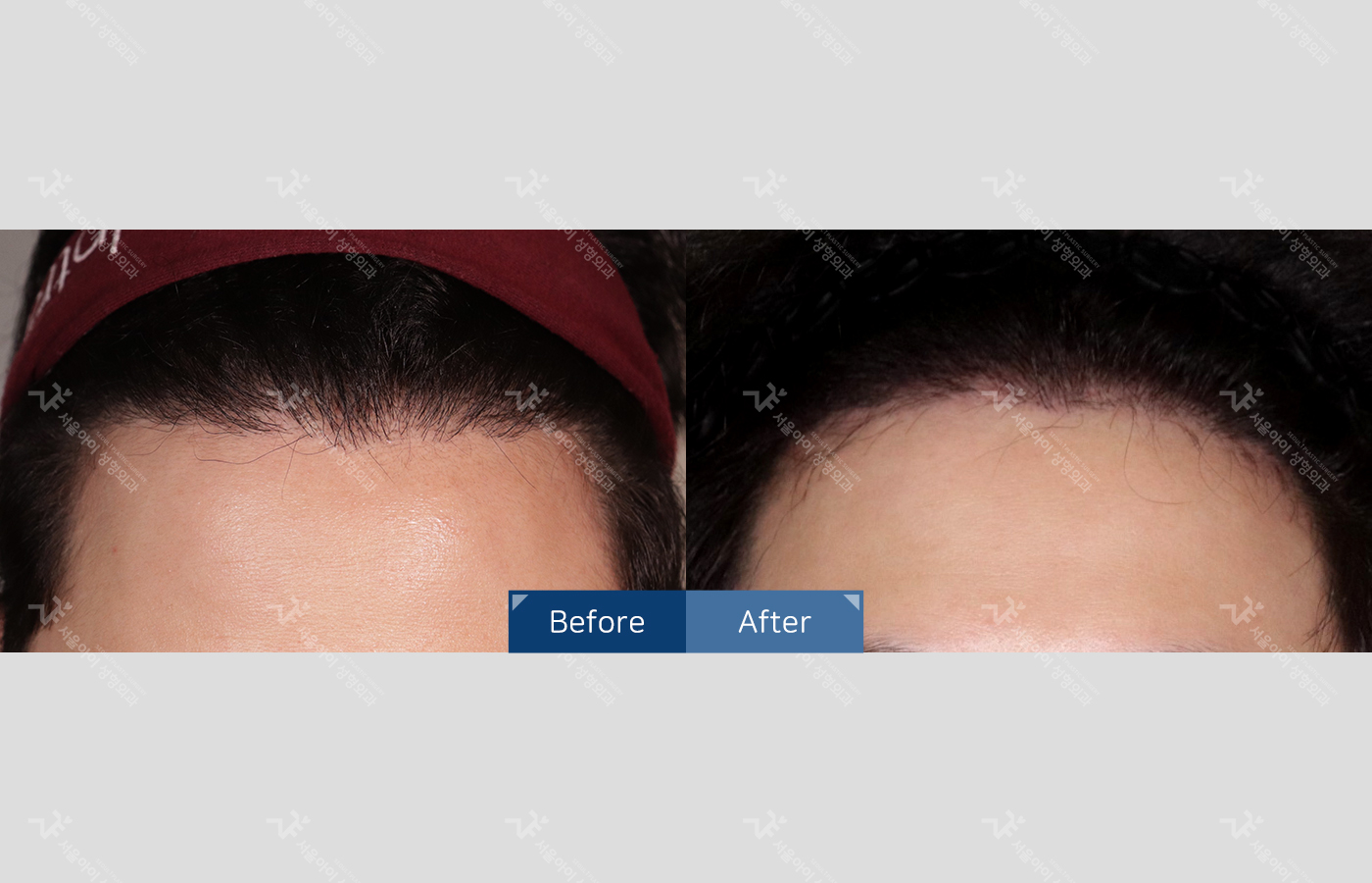 모발이식 [절개 모발이식(4000모) + 헤어라인]