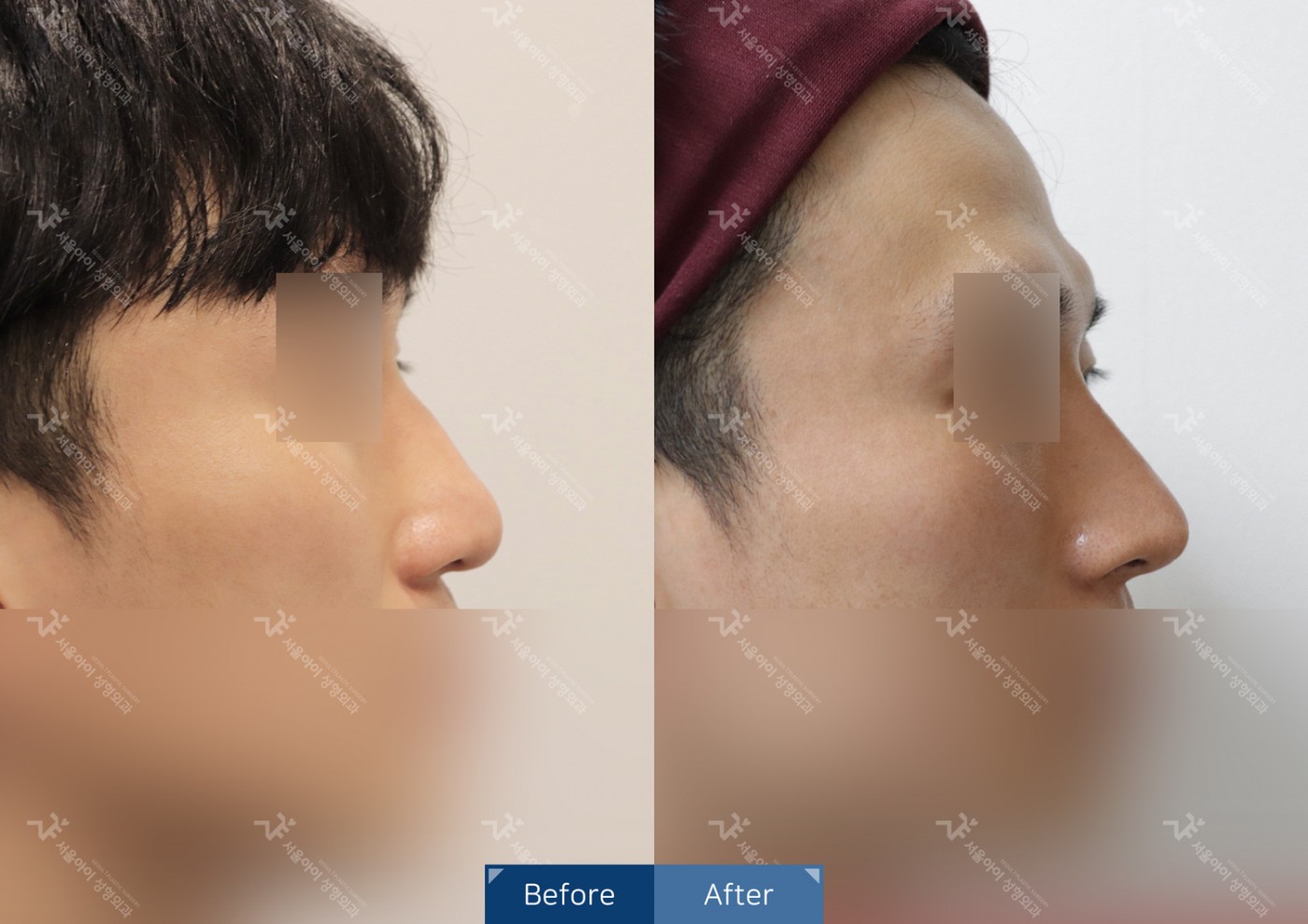 코성형 [비절개콧볼축소+하이코]