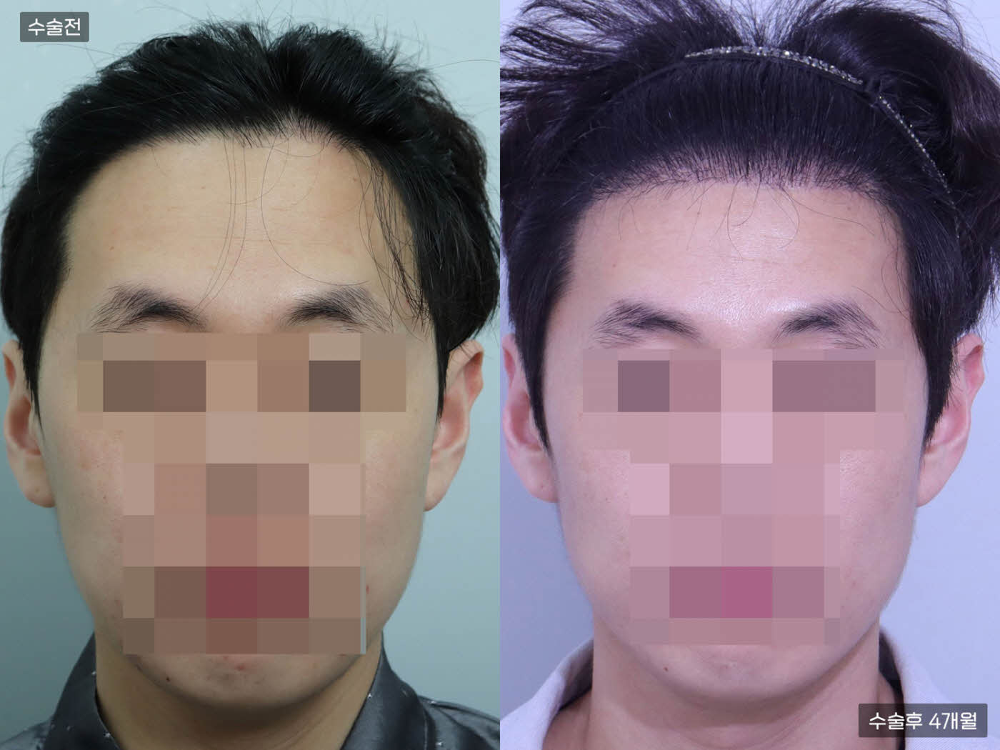 모발이식[절개 모발이식(4000모)]