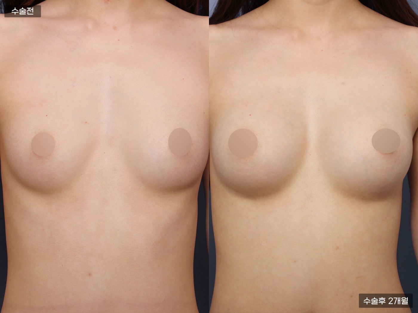 가슴성형 [가슴지방이식]