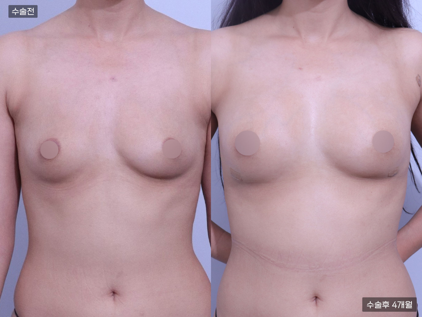 가슴성형 [가슴지방이식(150CC + 150CC)]