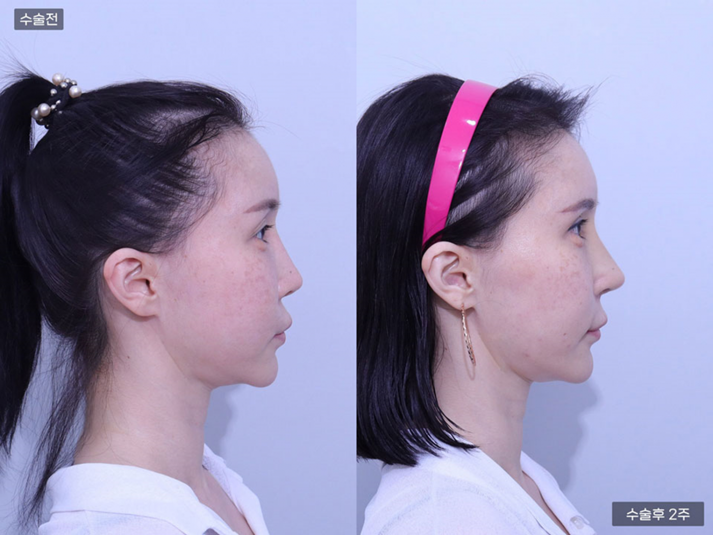 코끝(비중격) + 콧볼축소