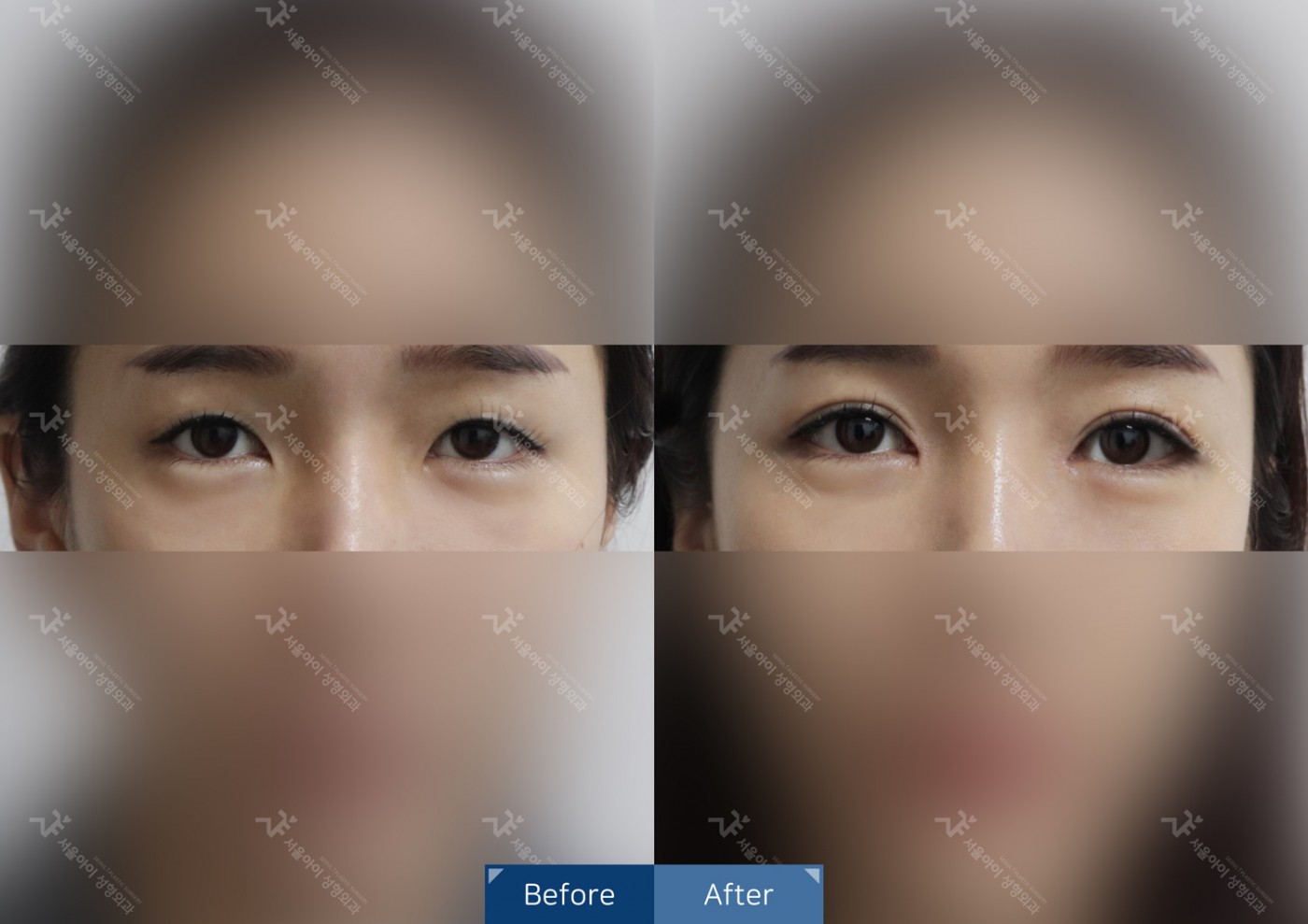 눈성형 [자연유착 + 뒷트임]