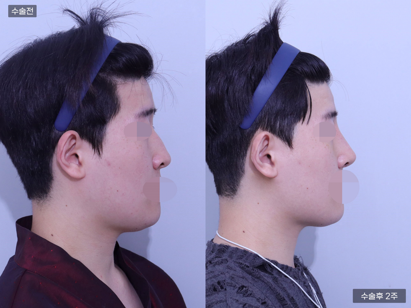 코끝 + 복코 + 매부리코 + 콧볼축소