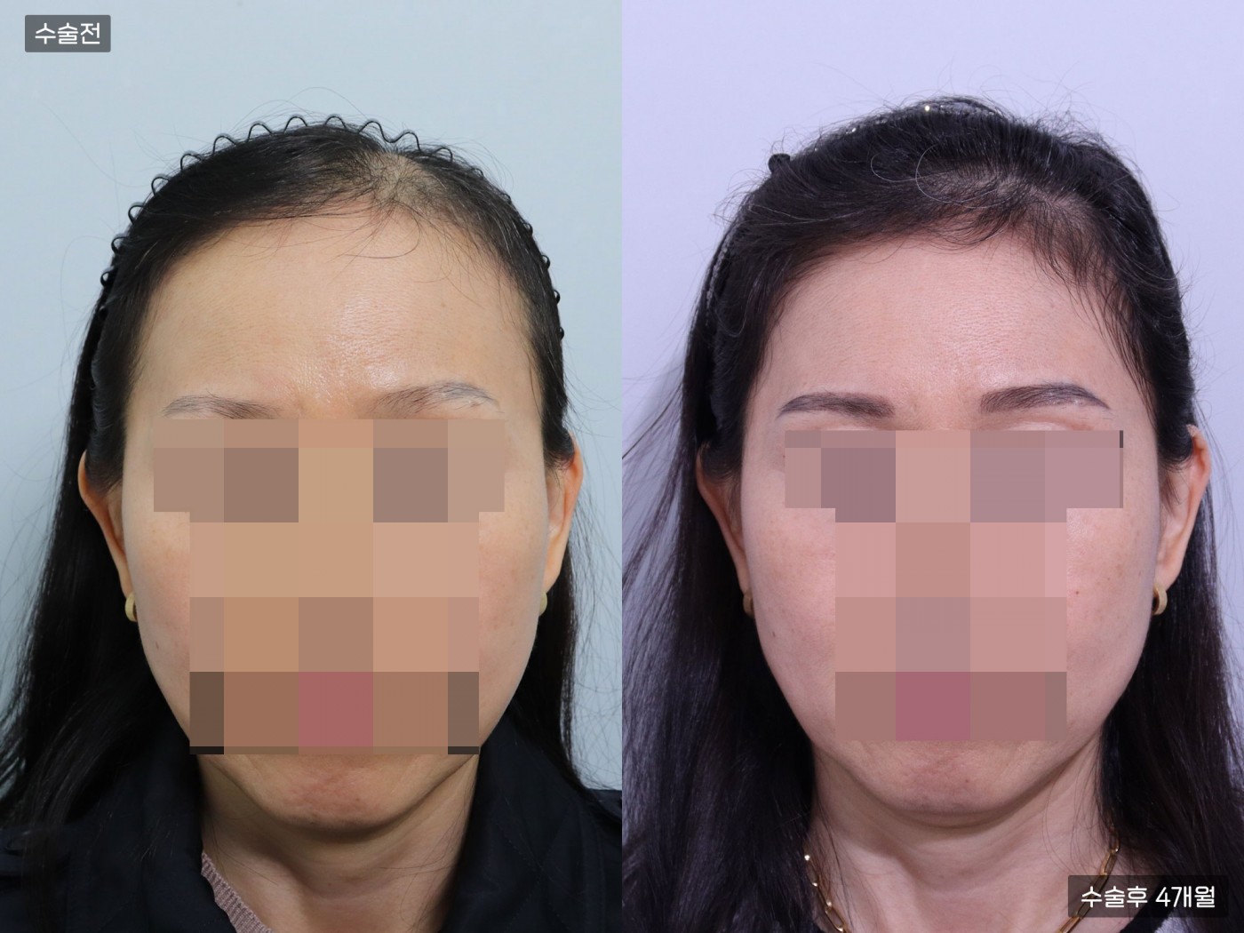 모발이식 [비절개 모발이식(4500모)]