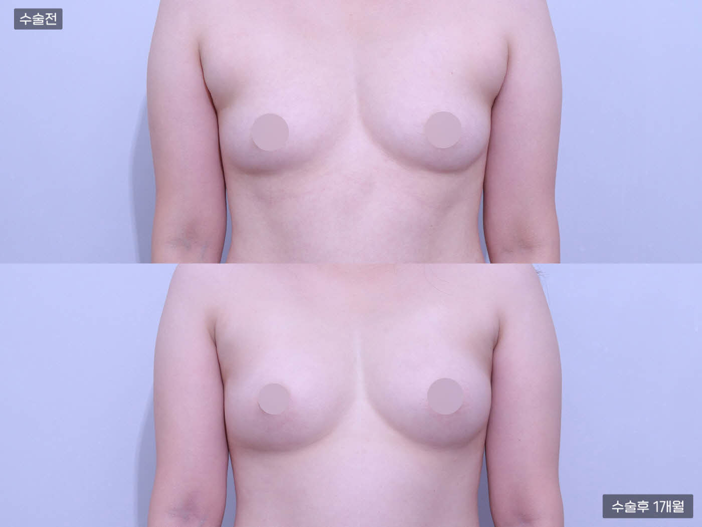 지방흡입(팔) + (380cc+400cc)가슴지방이식