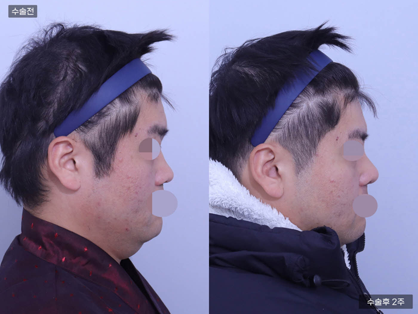 코끝(비중격) + 복코 + 매부리코