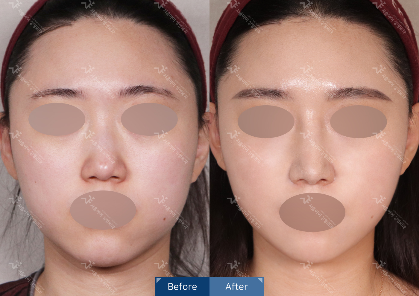 리프팅 [미니리프팅]