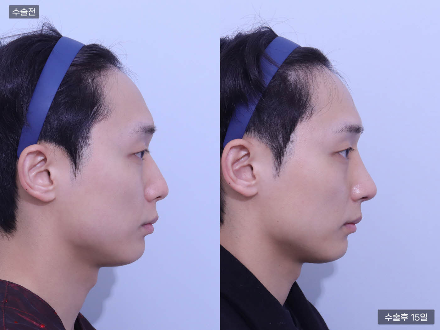 낮은코 + 코끝 + 복코