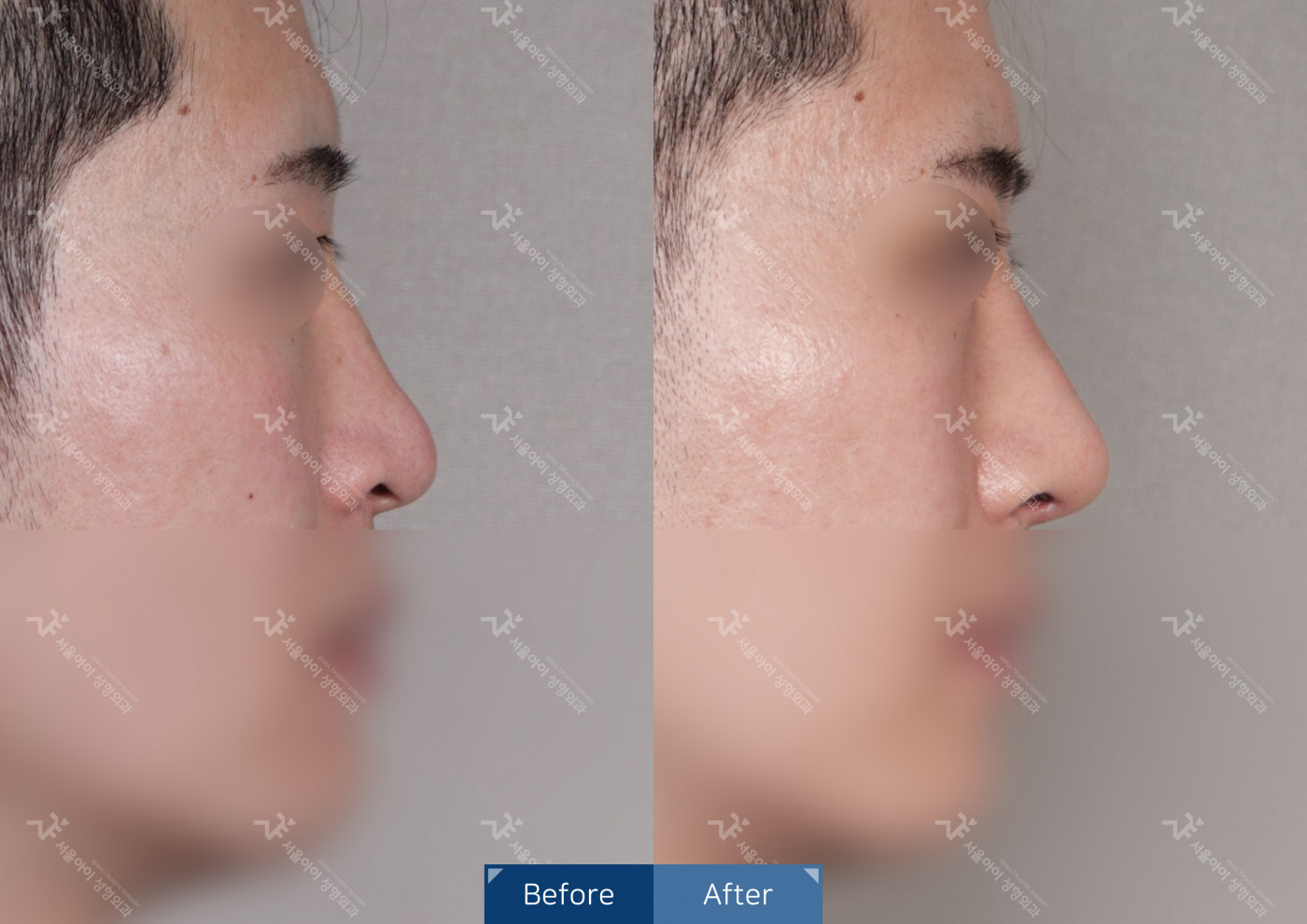 코성형 [코끝조각술(비중격)+복코교정술+메부리코]