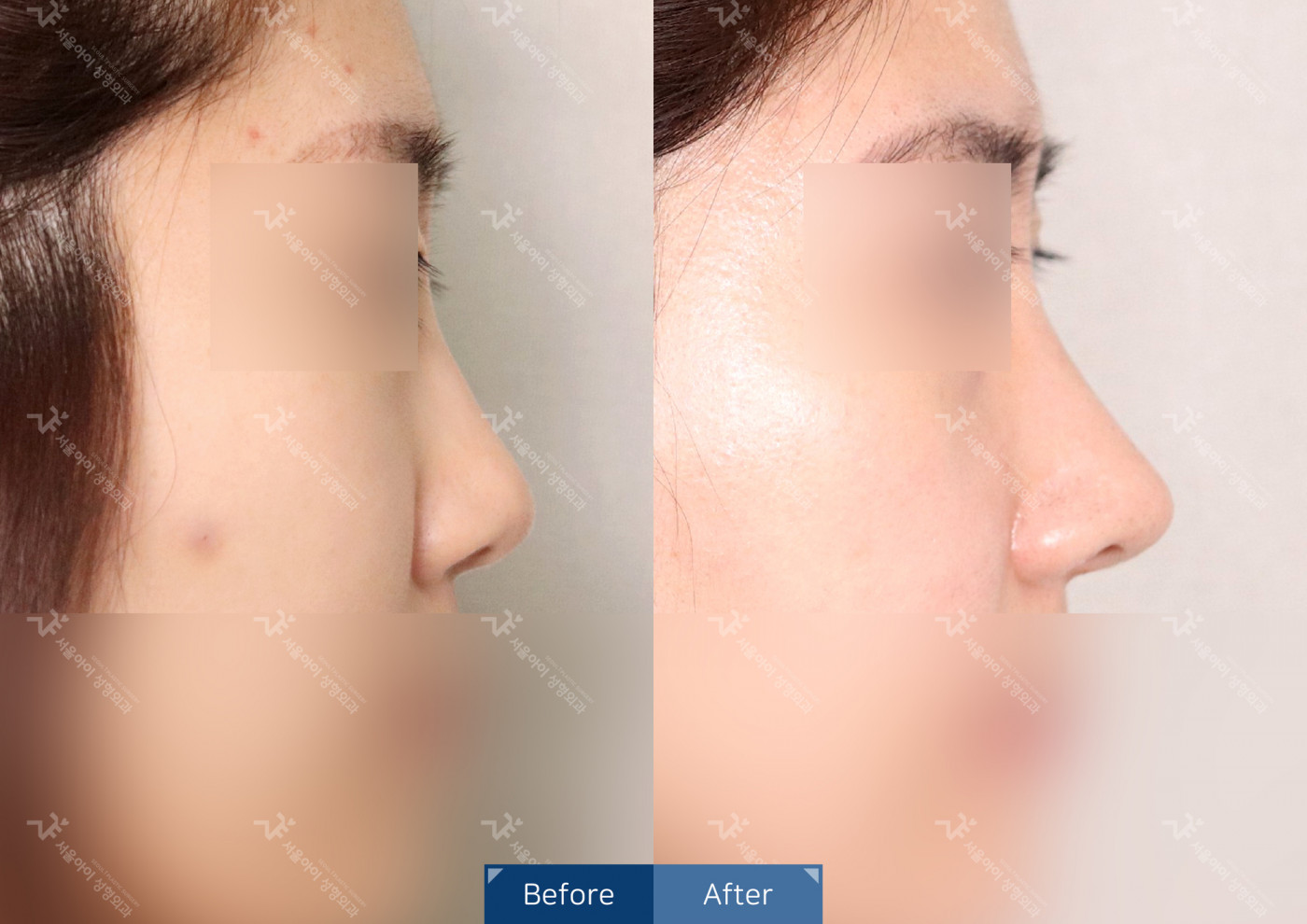 코성형 [코끝조각술(비중격)+복코교정]