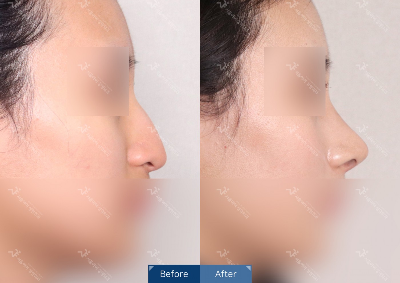 [코성형] 코끝조각술(비중격)+복코교정+매부리코교정+기능코성형