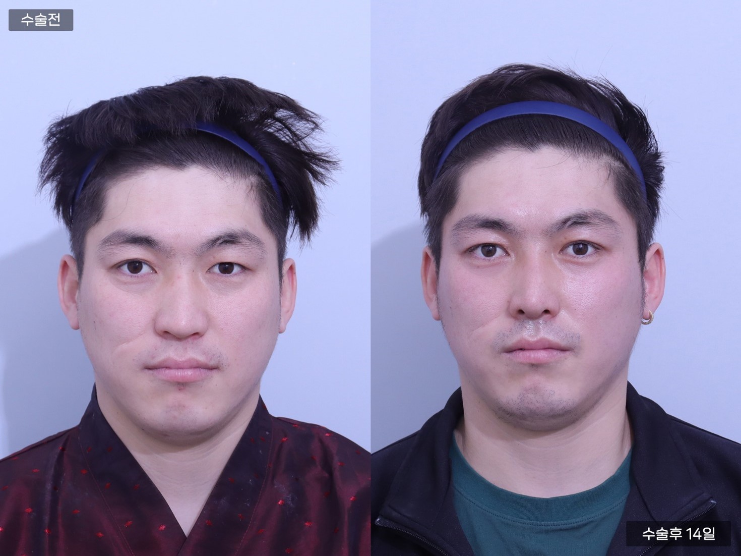 휜코교정 + 코끝교정 + 비중격