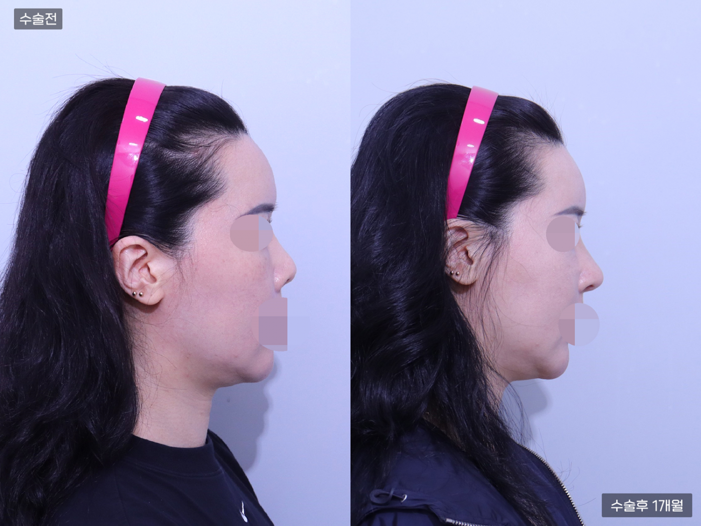 코재수술 + 코끝 + 복코