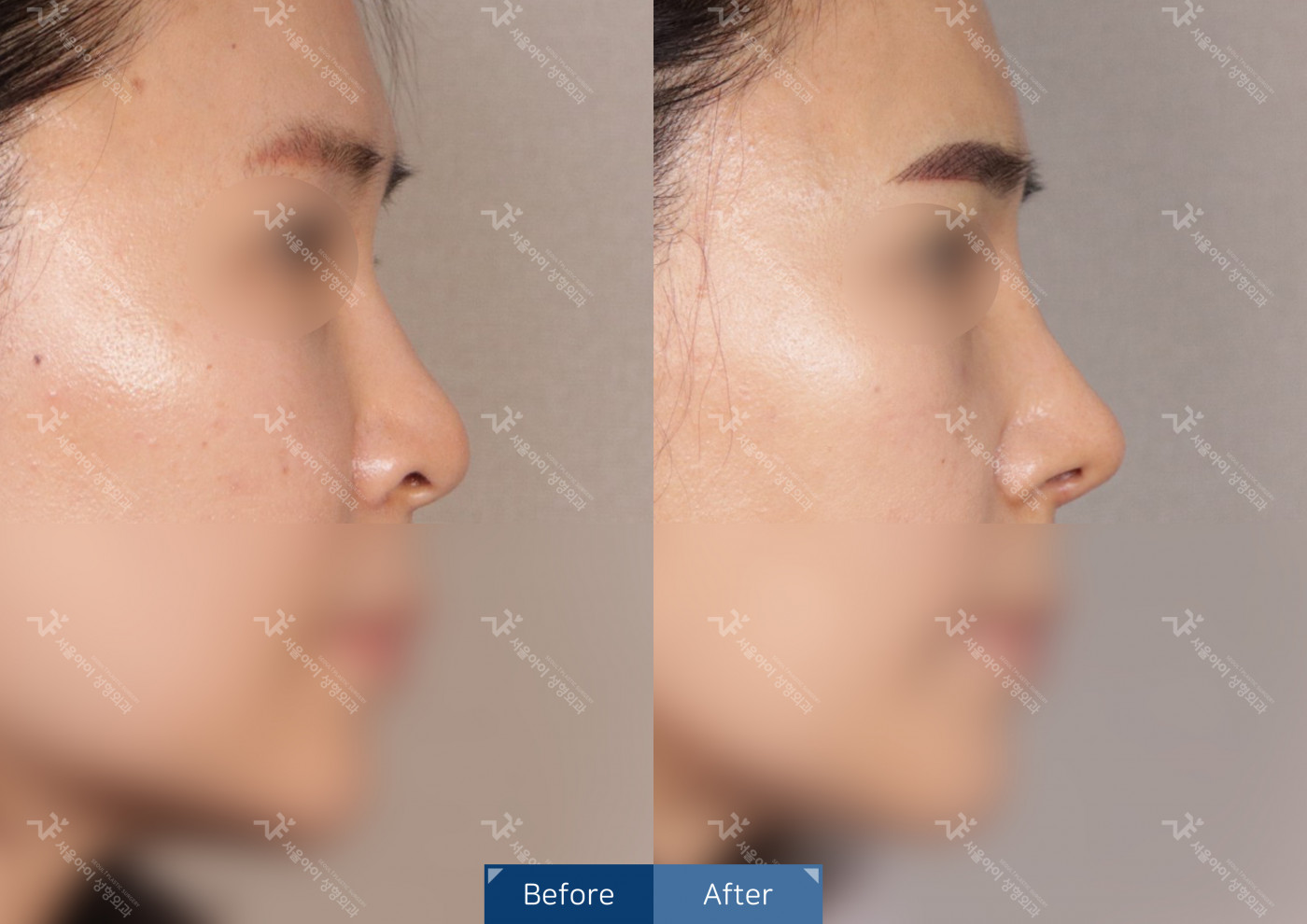 코성형 [코끝조각술+복코교정술+휜코교정술+비중격]