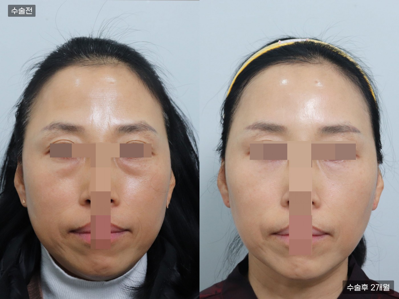 지방이식 [풀페이스]