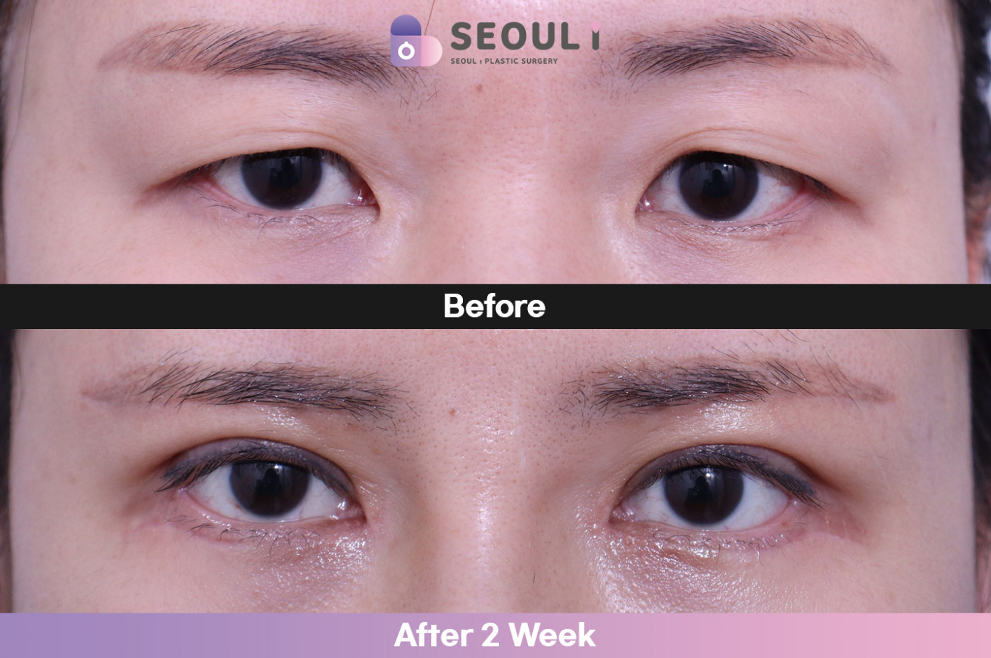 눈성형 [눈썹하거상술 + 자연유착 + 눈매교정 + 앞트임 + 뒷밑트임]