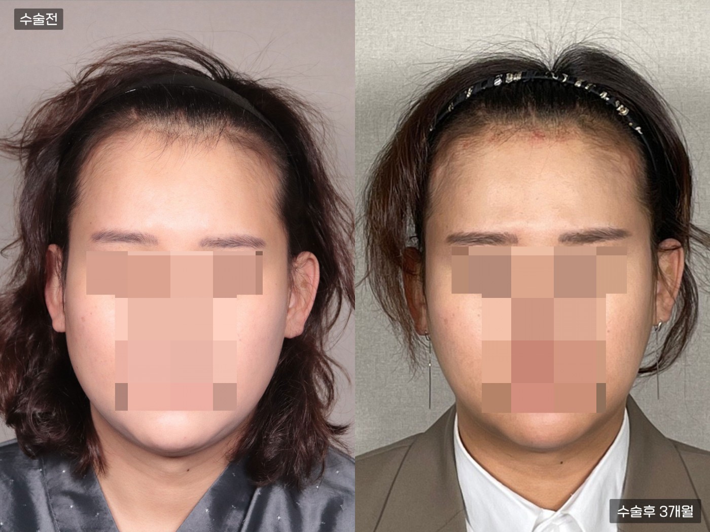 모발이식[절개 모발이식(6000모)]